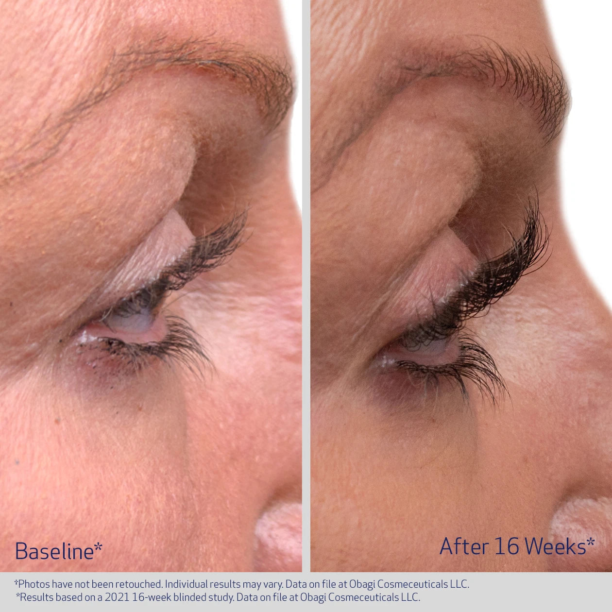 OBAGI NU-CIL LASH BEFORE AND AFTER 16 WEEKS | VISIBLE IMPROVEMENT IN THICKNESS OF EYELASHES | PARTICIPANT 1