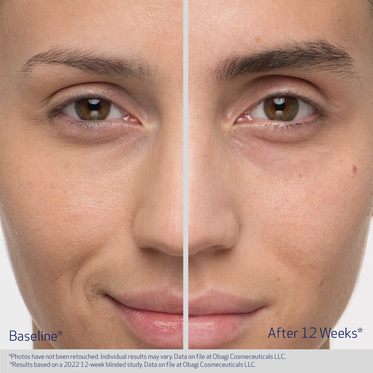 OBAGI NU-CIL BROW BEFORE AND AFTER 12 WEEKS | VISIBLE IMPROVEMENT IN THICKNESS AND DARKNESS OF EYEBROWS| PARTICIPANT 2