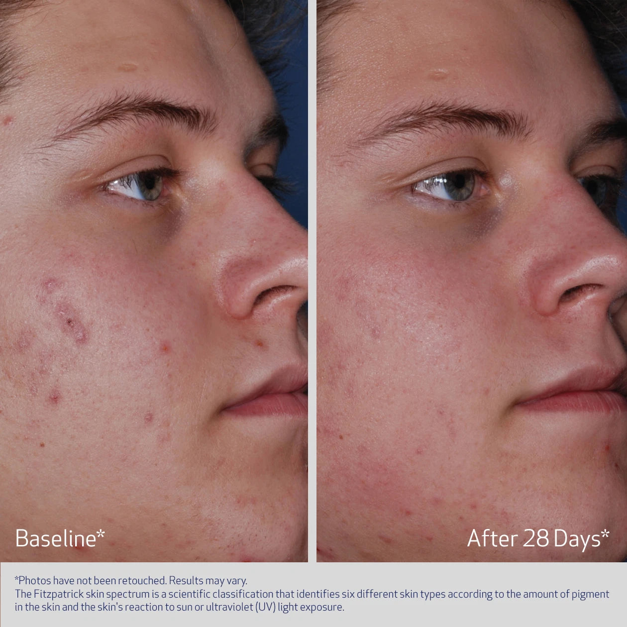 CLENZIDERM ACNE SYSTEM BEFORE AND AFTER AFTER 28 DAYS - PARTICIPANT 2