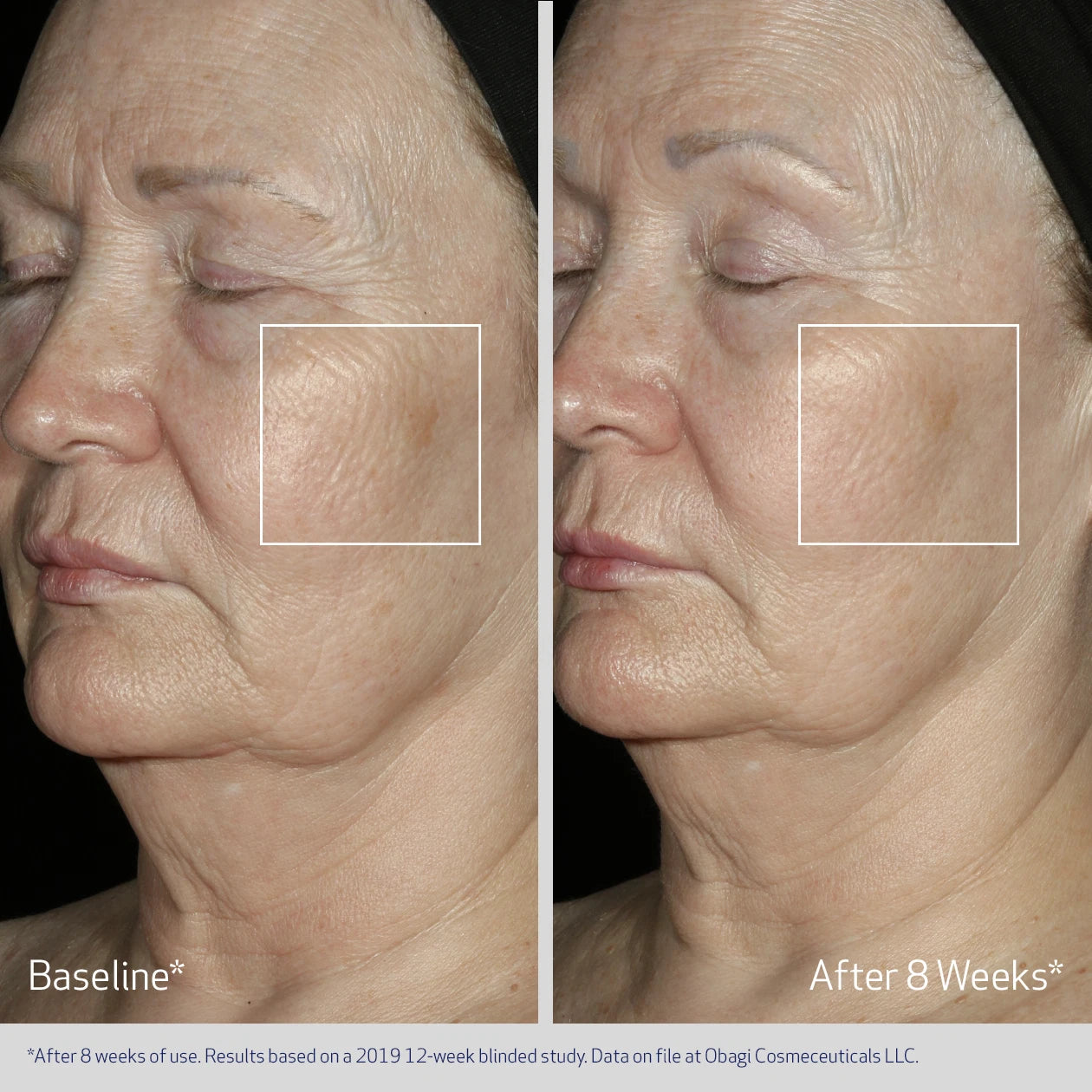 ELASTIDERM FACIAL SERUM BEFORE AND AFTERM8 WEEKS | VISIBLE IMPROVEMENT IN SKIN LAXITY AND FINE LINES | PARTICIPANT 2