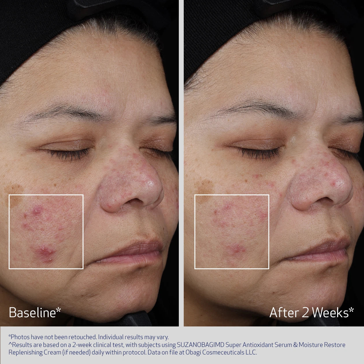 SUZANOBAGIMD SUPER ANTIOXIDANT SERUM BEFORE & AFTER REDUCTION IN REDNESS AND BLEMISHES